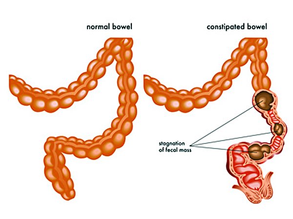 does-constipation-have-a-harmful-effect-on-your-prostate-gland